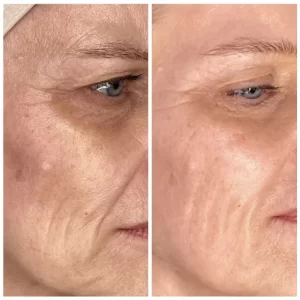 Neveskin Ultra Lift